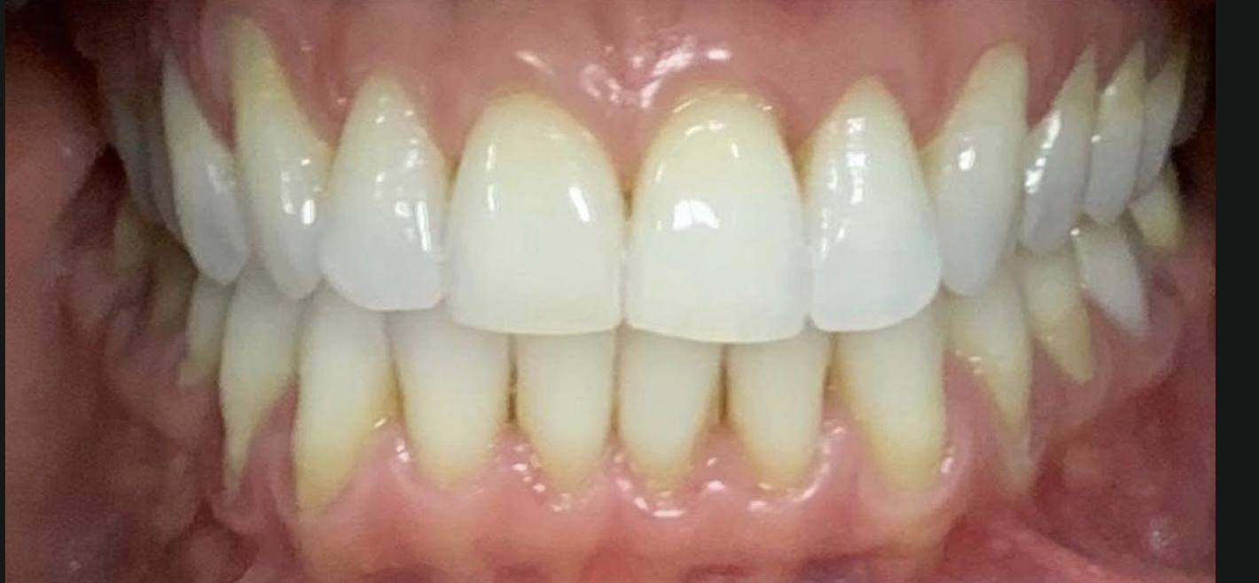 Depois — Clareamento profissional — caso real da Tok Odontologia